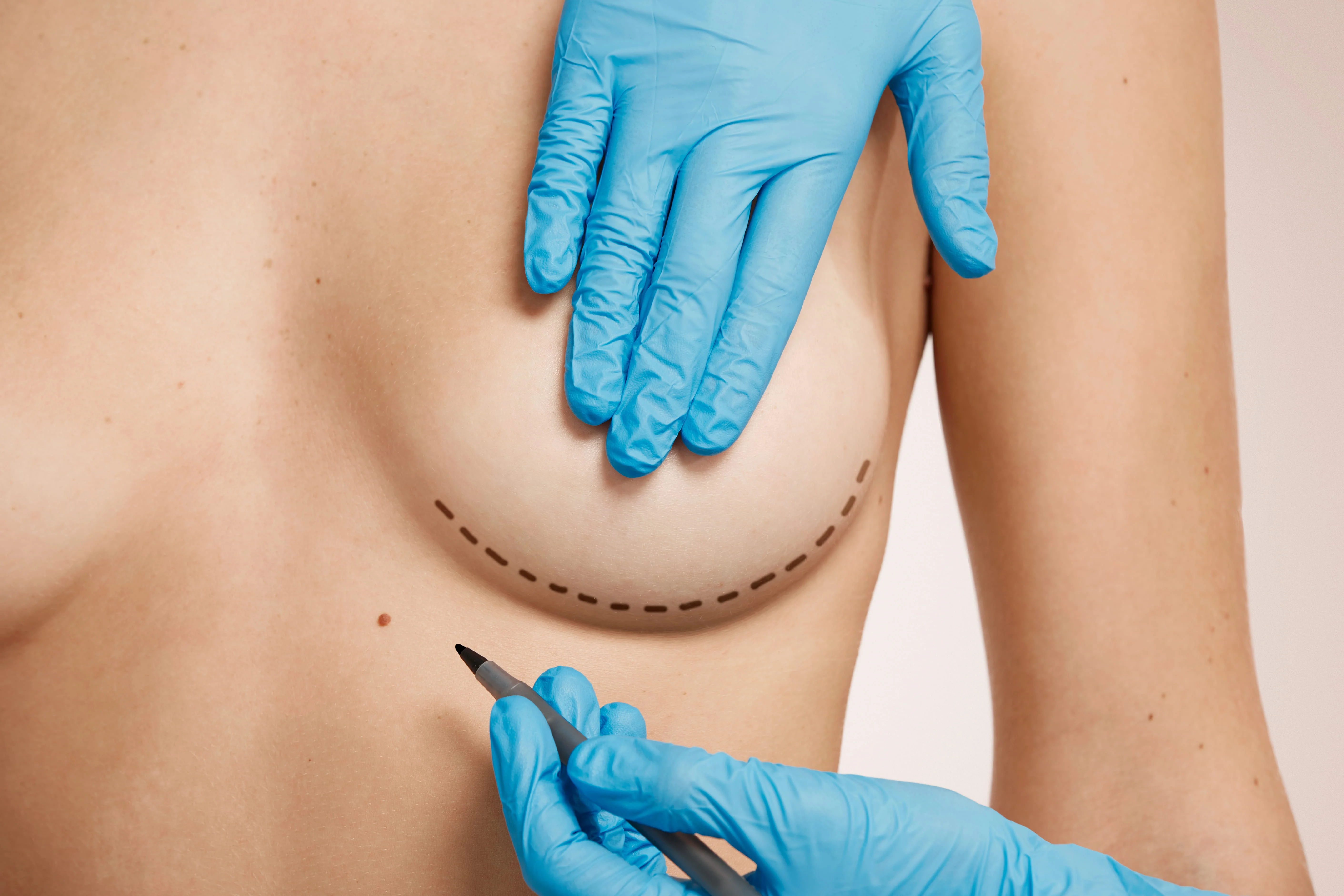 Breast Conservation Surgeries and Oncoplasty