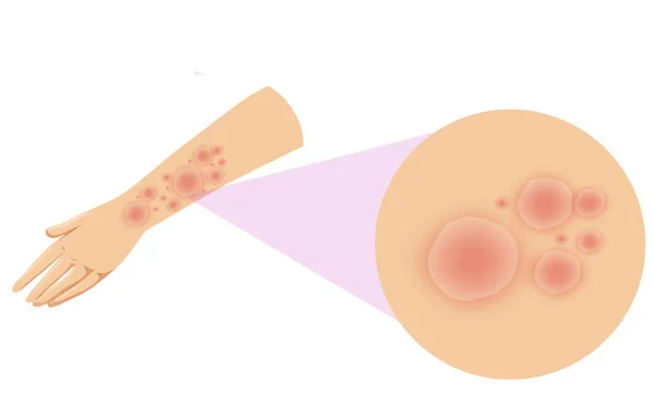 Extremity Soft Tissue Sarcomas