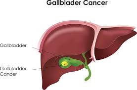 Is Robotic Cancer Surgery the Right Choice for You?