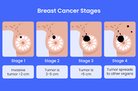 When Should You Consult a Specialist for Breast Cancer Care?